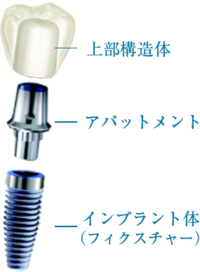 インプラントの構造 インプラントは上部構造体、アバットメント、インプラント体の3つの部位から構成