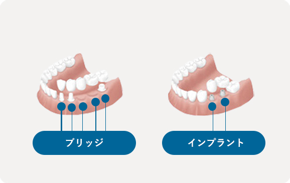 隣の歯への侵襲が少ない